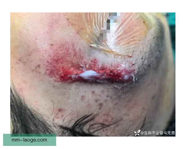 格罗索执教里昂遭球迷袭击面部受伤紧急缝针事件引关注
